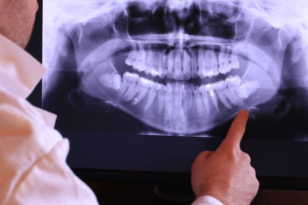 Best Emergency Wisdom Teeth Removal in Olivette, MO