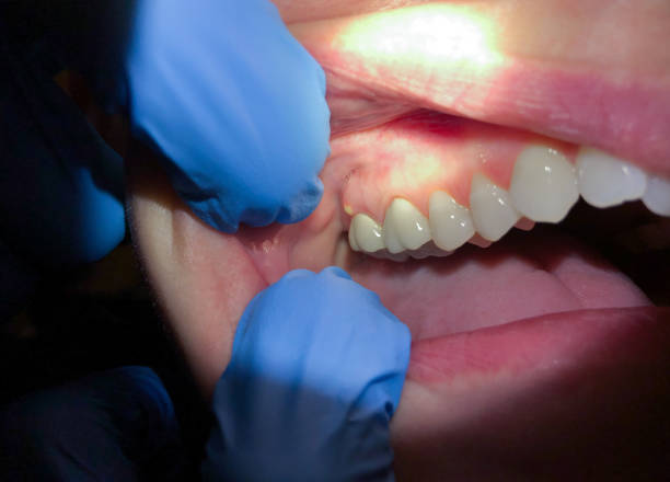 Best Emergency Tooth Extraction in Olivette, MO